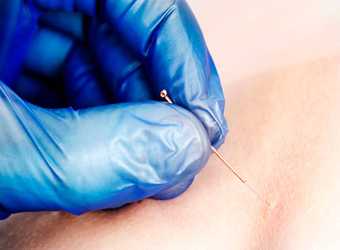 Best Physiotherapy Dry Needlling Clinics Services in Madurai, Best Physiotherapy Dry Needlling Center in Madurai