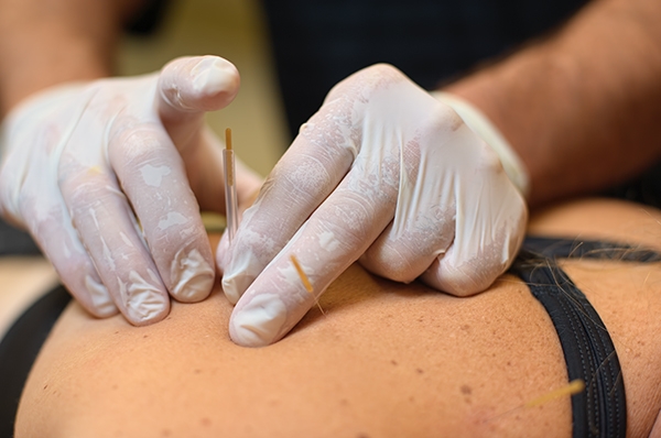 Best Physiotherapy Dry Needling Services in Madurai, Best Physiotherapy Dry Needling Center in Madurai