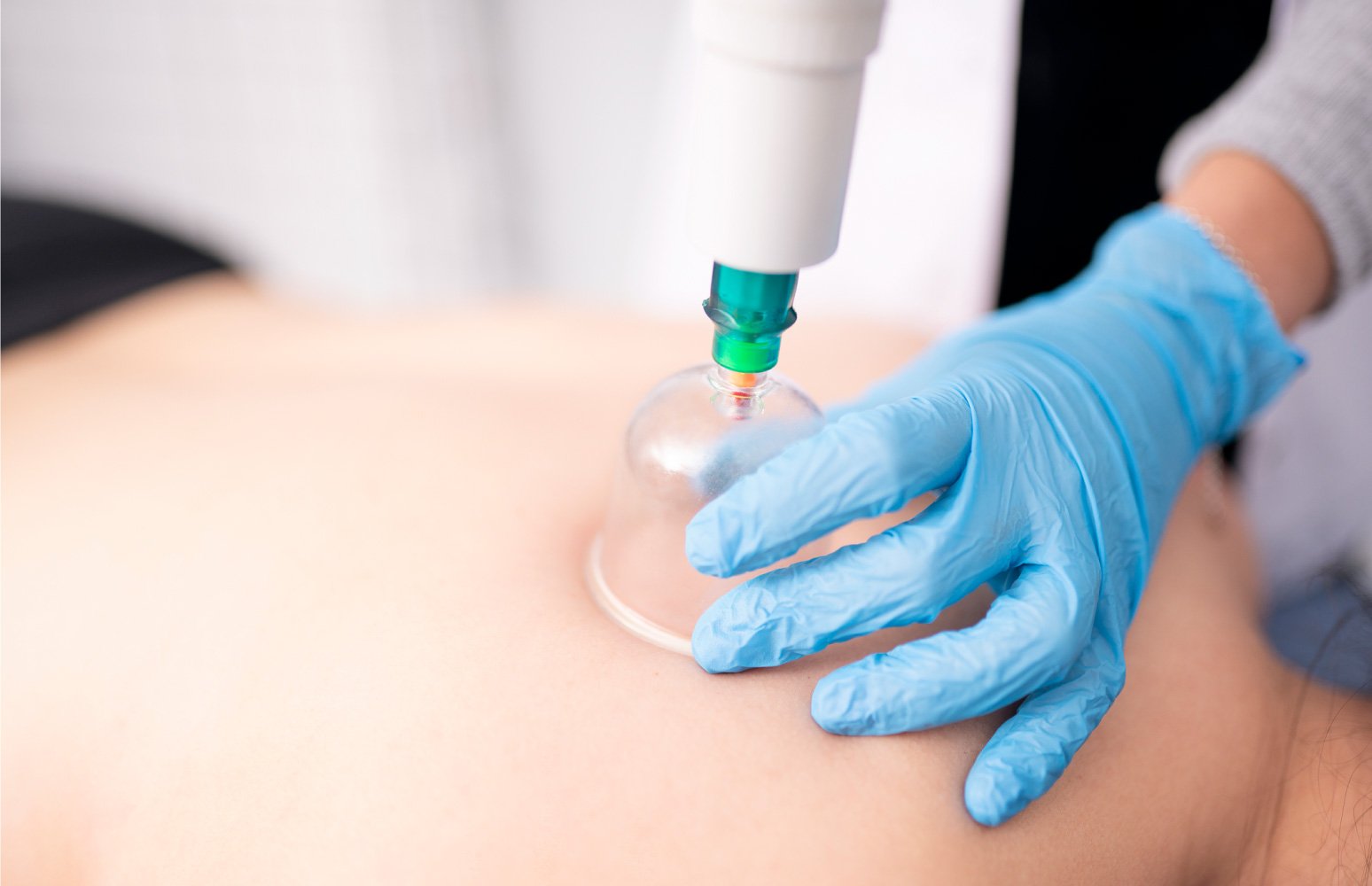 Best Physiotherapy Cupping Therapy Services in Madurai, Best Physiotherapy Cupping Therapy Center in Madurai